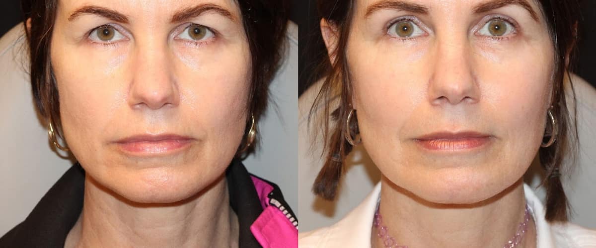 Boston Eyelid Surgery in Boston, Massachusetts