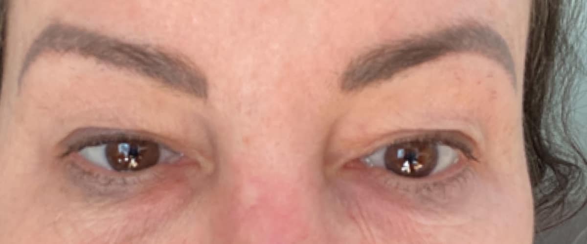 Dr. Mitesh Kapadia - Eyelid Surgery, Botox & Restylane in Newton, Massachusetts