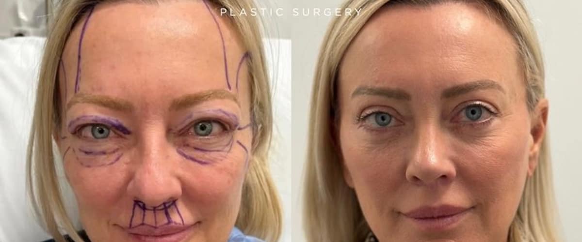 Kassir Plastic Surgery in New York, New York